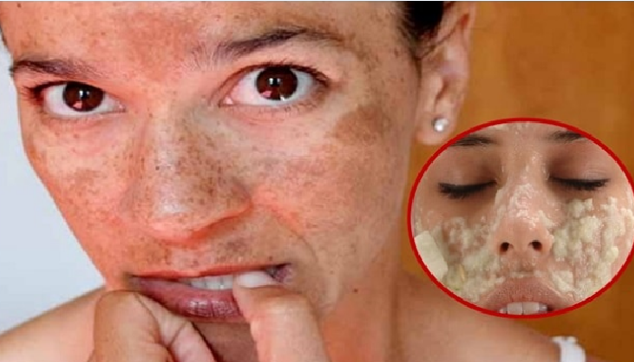 Cómo quitar las manchas de sol de la cara