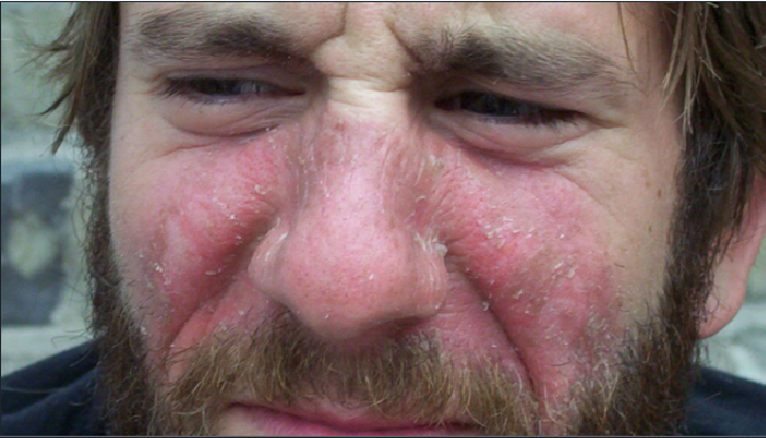 3 remedios caseros para quitar las manchas rojas de la cara: