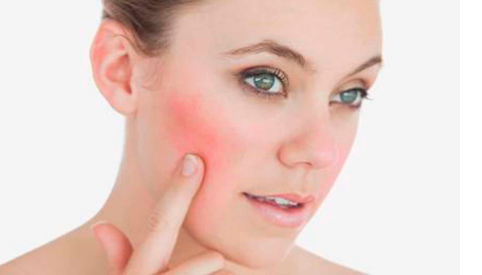 Cuidado personal y estilo de vida que pueden servirte para controlar las manchas rojas en la cara: