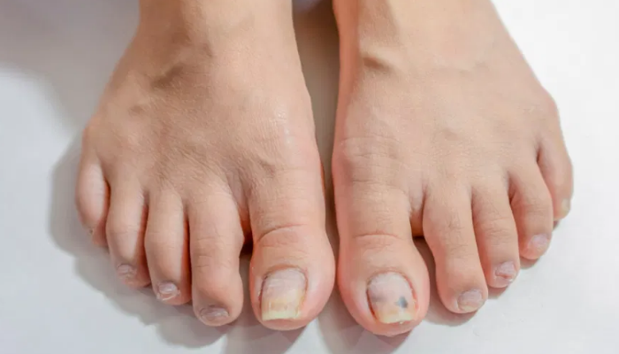 Qué puede originar los hongos en las uñas de los pies