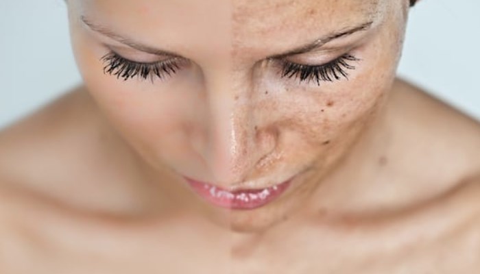 Cómo quitar manchas en la cara – Con 5 métodos prácticos