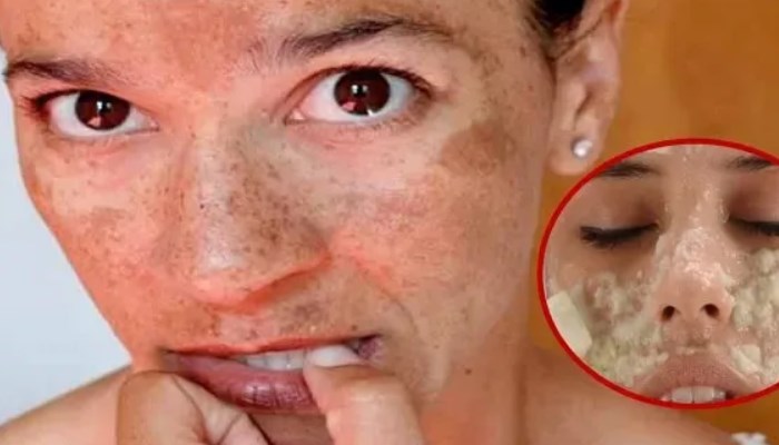 cómo quitar manchas en la cara
