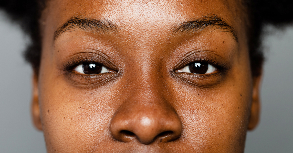 Comprender cómo afecta la hiperpigmentación a la piel negra