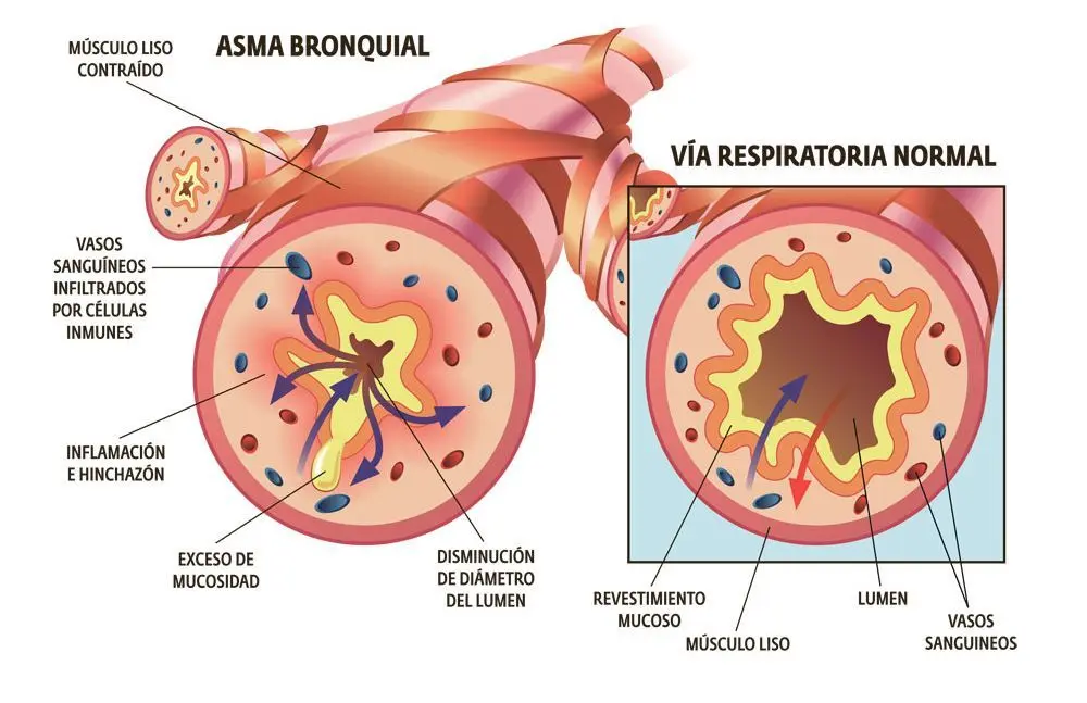Asma y bronquitis es lo mismo
